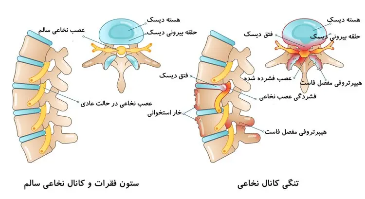 تنگی کانال نخاعی