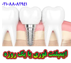 ایمپلنت فوری