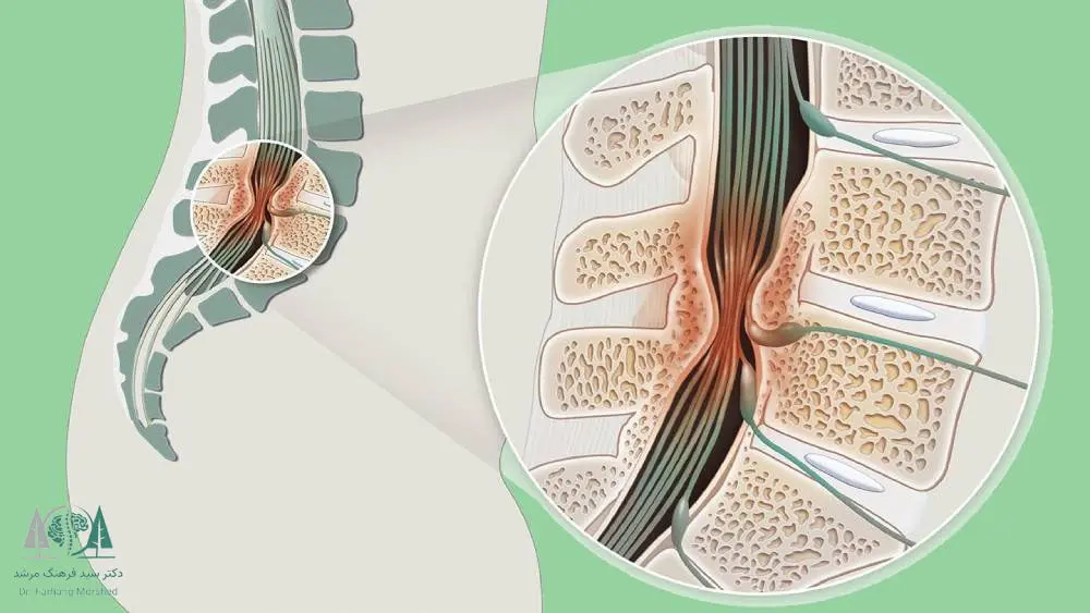 تنگی کانال نخاعی