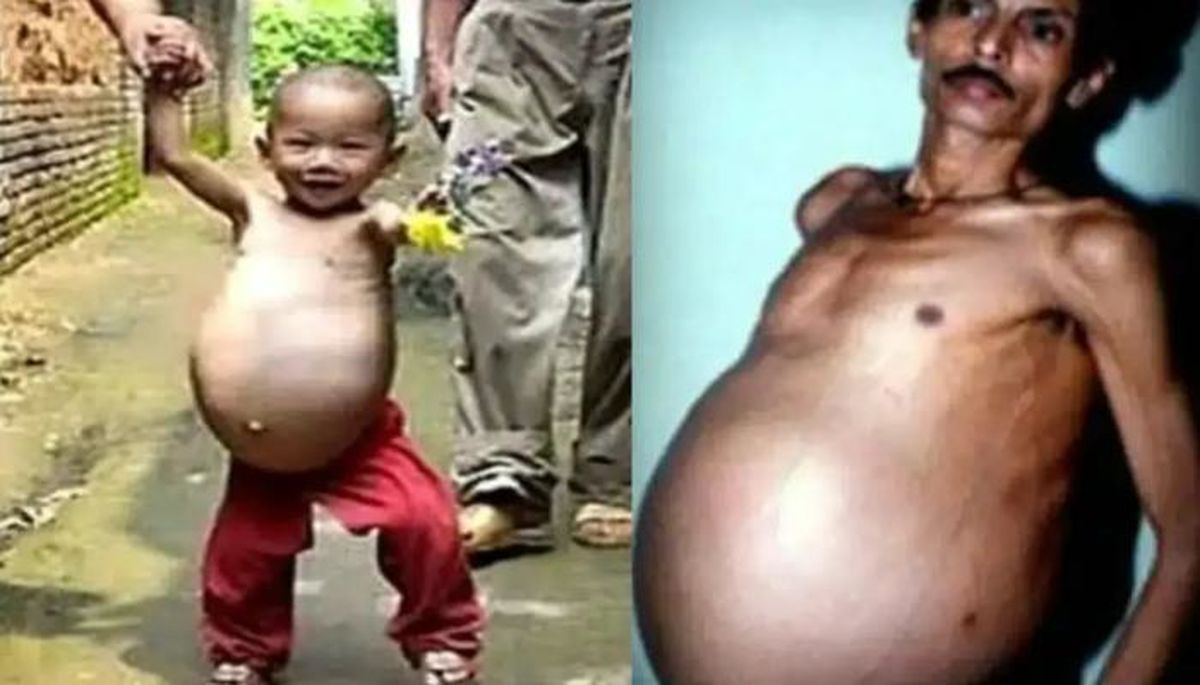 این مرد هندی ۳۶ سال بدون اینکه بداند «باردار» بود