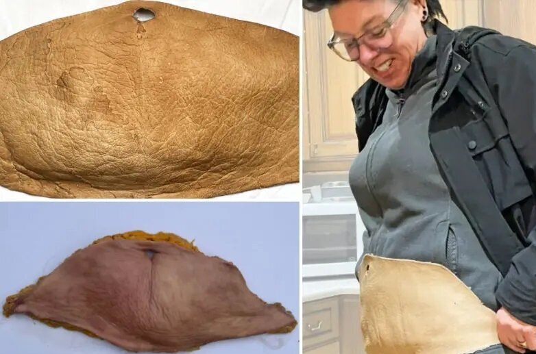 تبدیل پوست شکم به چرم انسانی
