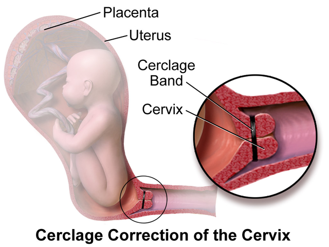 Cervical_Cerclage