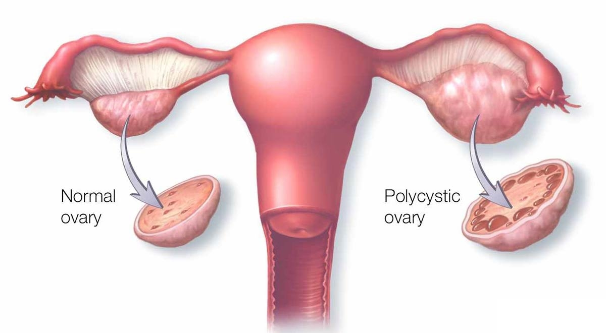 سندرم تخمدان پلی کیستیک