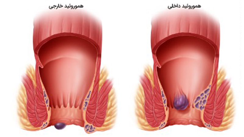 بواسیر خارجی و داخلی