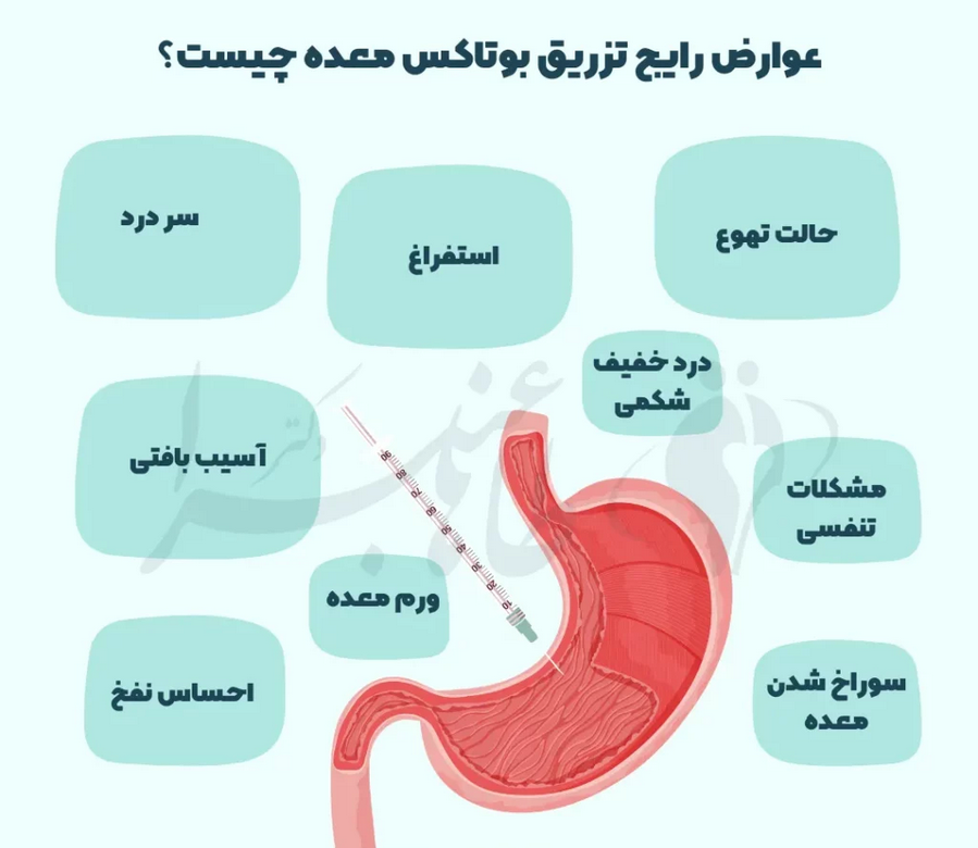 بوتاکس معده