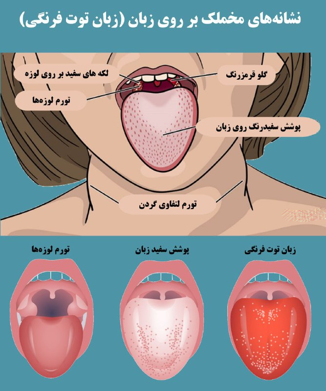 علائم مخملک روی زبان