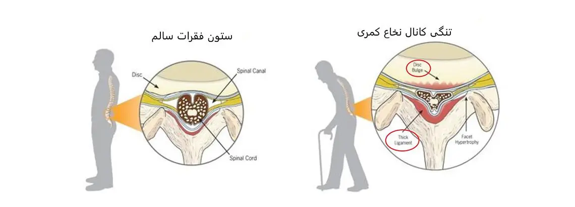 تنگی کانال نخاعی