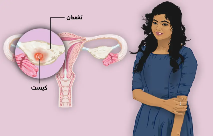 سندرم تخمدان پلی کیستیک