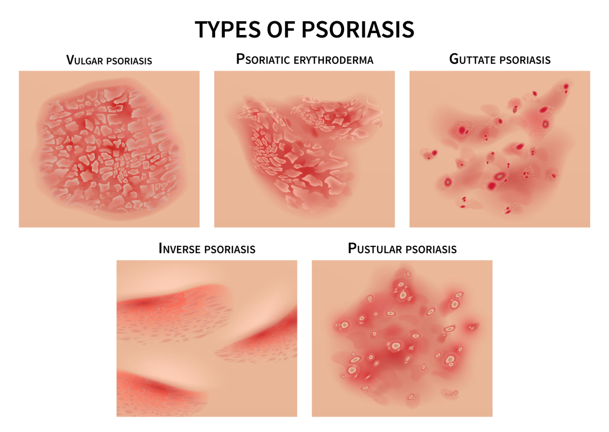 انواع  psoriasis