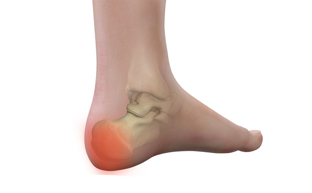 اختلال آرتروز در درد پاشنه پا