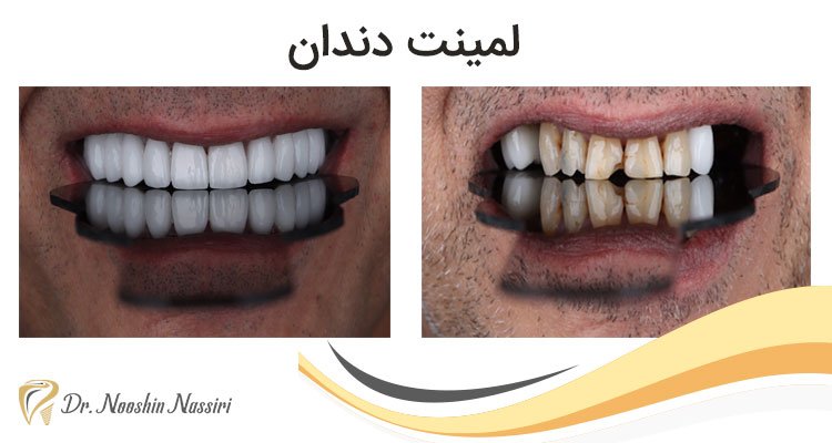 عکس لمینت دندان قبل و بعد