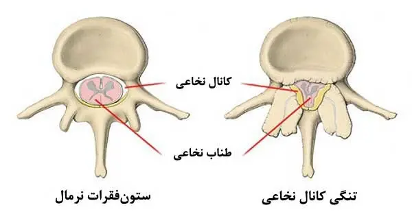 تنگی کانال نخاعی