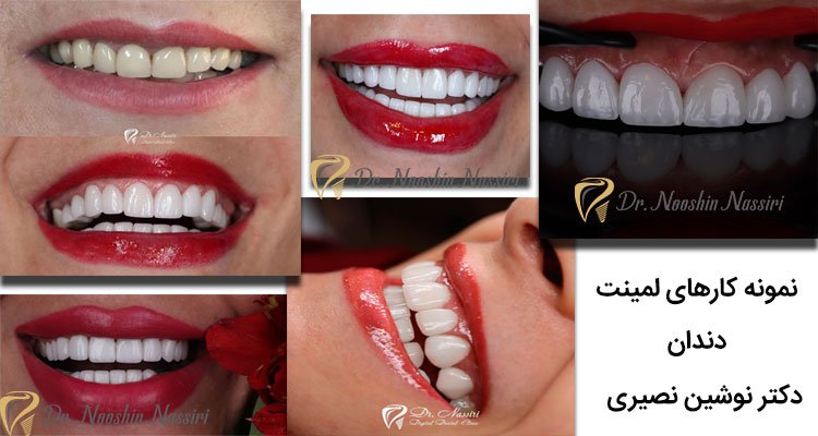 نمونه عکس های لمینت دندان دکتر نصیری