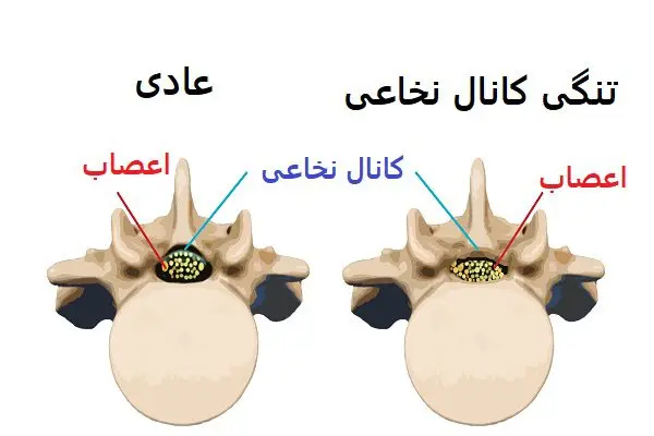 تنگی کانال نخاعی