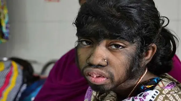 بیماری ناشناخته‌ ای این زنان را شبیه به هیولا کرد +تصاویر
