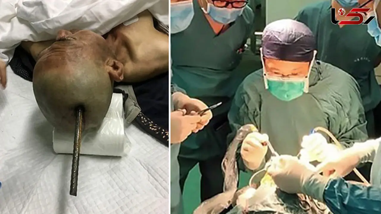 زنده ماندن مردی که میلگرد در جمجمه اش فرو رفت! +عکس های باورنکردنی
