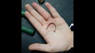 دردسر انگشتر برای دختر 11 ساله اهوازی / آتش نشانان دست به کار شدند + عکس

