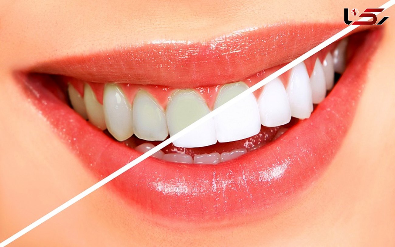 راز زیبایی دندان های سفید در ترفندهای خانگی
