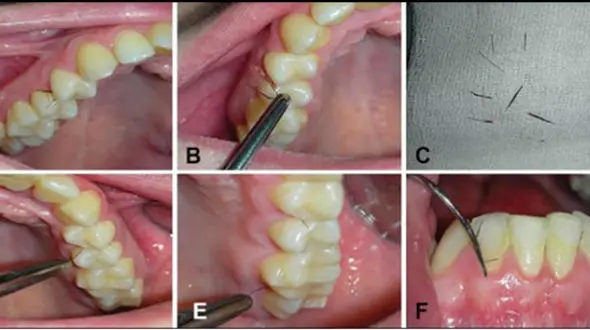 رشد مو روی لثه زن جوان+عکس