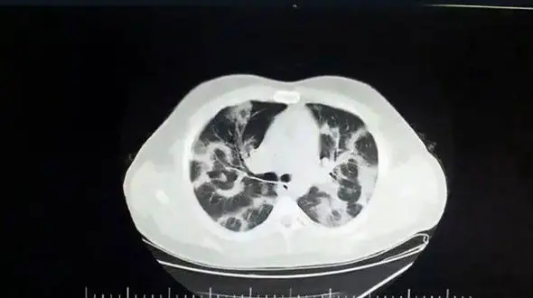 اولین عکس از ریه کرونایی انگلیسی / هشدار برای زیر 20 ساله ها!