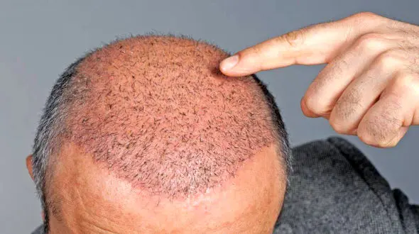 معایب کاشت مو