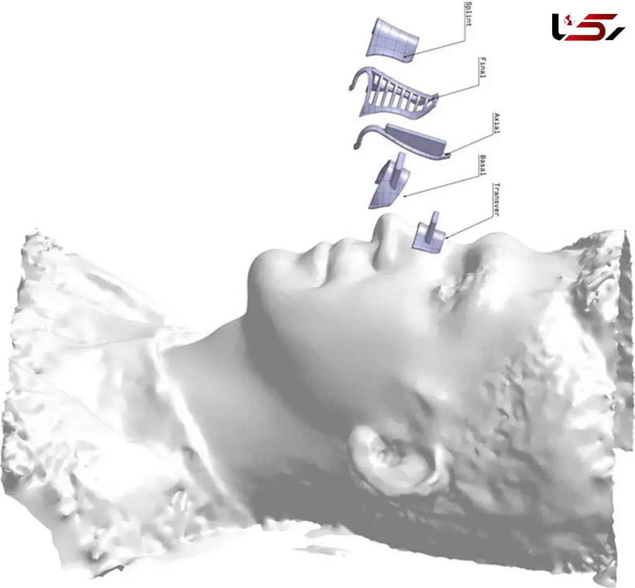 شایع ترین سن جراحی زیبایی بینی