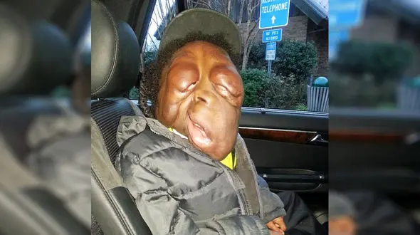 ببینید چگونه بیماری این پسر بچه چهره او را وحشتناک و شبیه موجودات فضایی کرده است + عکس