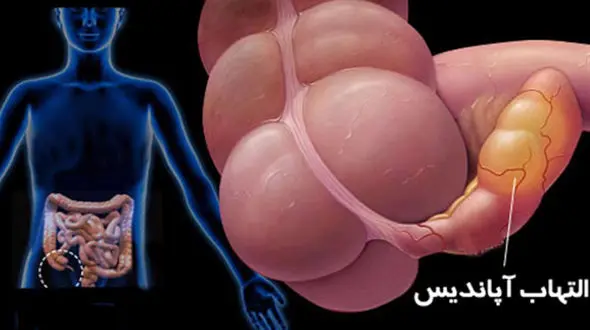 آپاندیس چیست؟