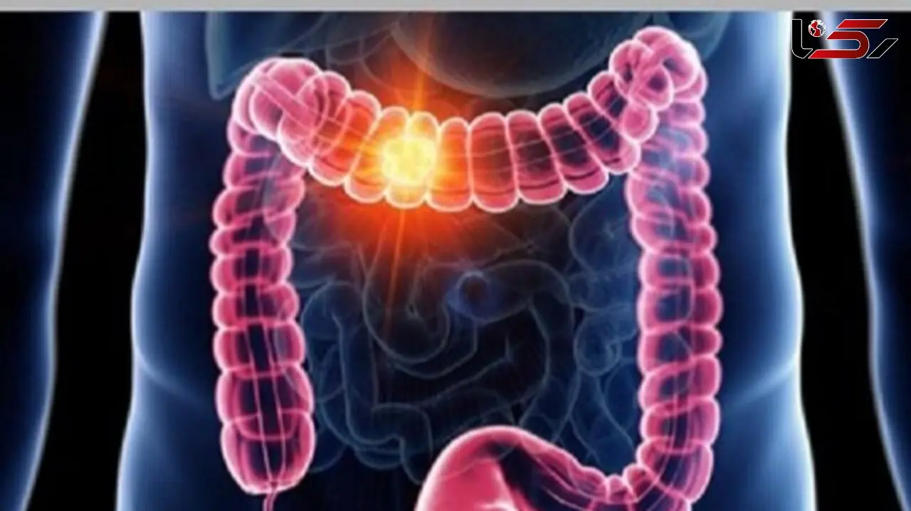 سرطان روده: علائم، پیشگیری و اهمیت تشخیص زودهنگام