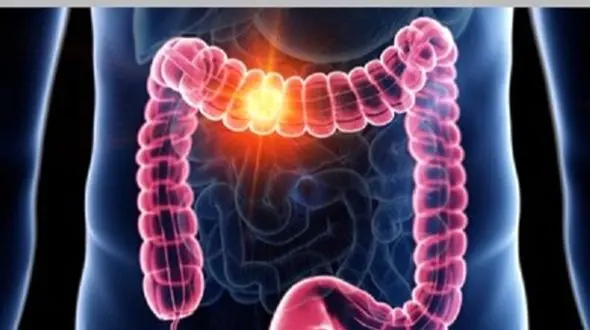 سرطان روده: علائم، پیشگیری و اهمیت تشخیص زودهنگام