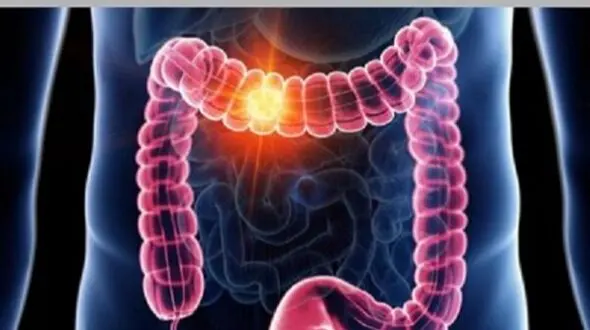 سرطان روده: علائم، پیشگیری و اهمیت تشخیص زودهنگام