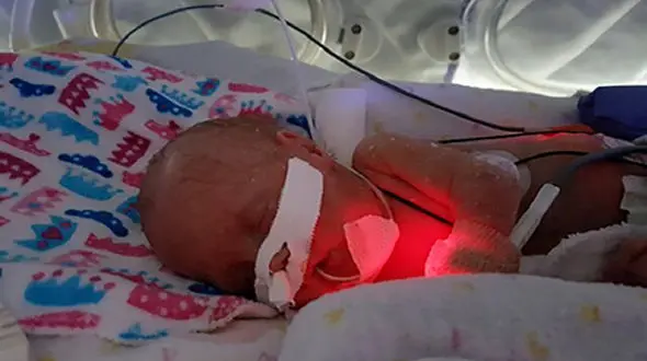 ارتباط زایمان زودرس با اختلالات تیروئید