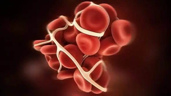 6 نشانه که حاکی از لخته شدن خون در بدن است