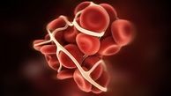 6 نشانه که حاکی از لخته شدن خون در بدن است