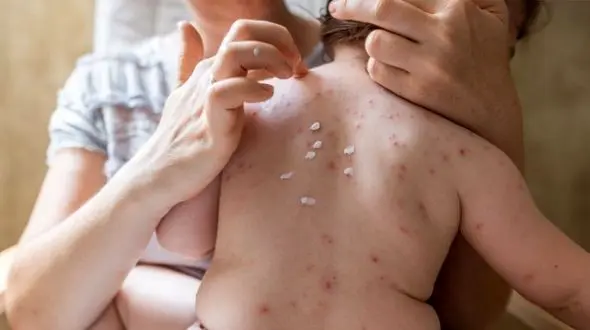 چرا آبله مرغان در فصل بهار شایع‌تر است؟ توصیه‌های بهداشتی