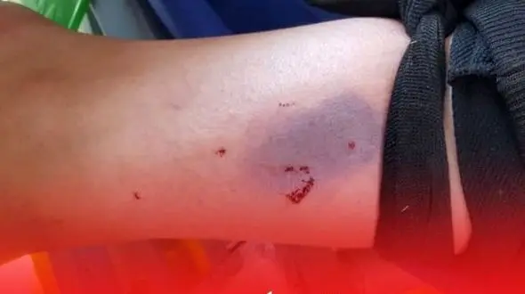 حمله نیش دار مارسمی به پسر 12 ساله ! / وحشت در خانه بیله سواری