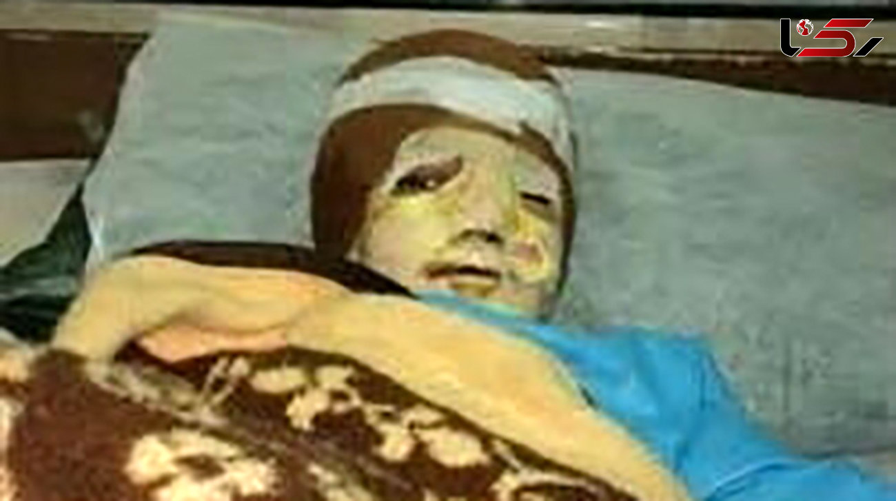 آخرین وضعیت درمانی کودک سوخته در دیگ نذری 