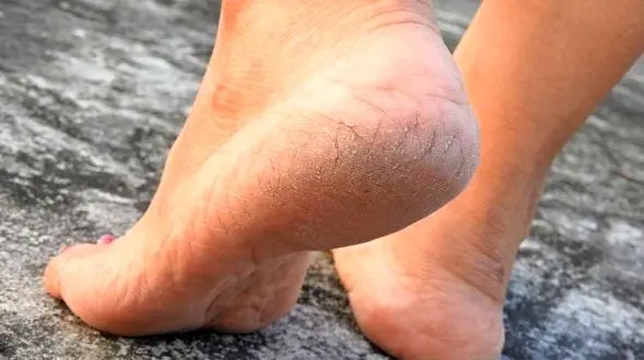 بهترین روش های رفع ترک پا + فیلم