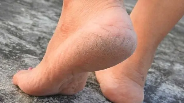 بهترین روش های رفع ترک پا + فیلم