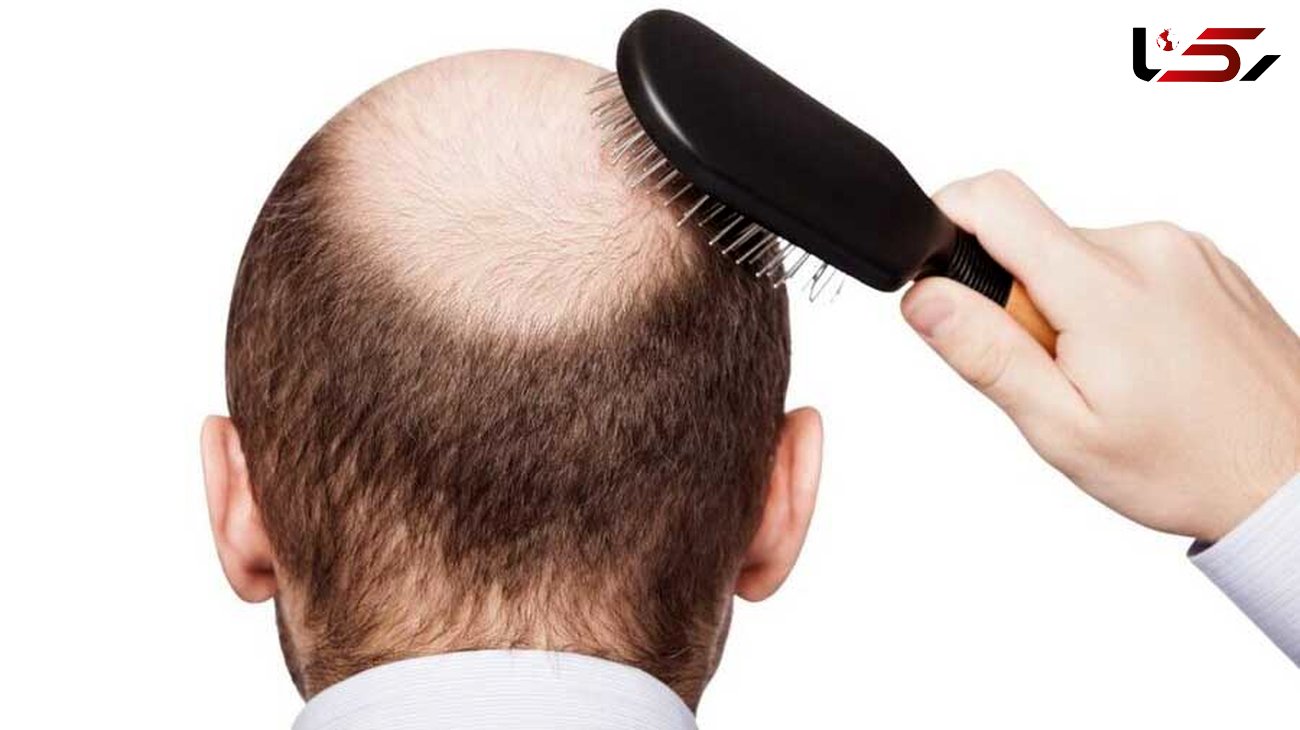 آیا درمان سریع ریزش مو امکان‌پذیر است؟