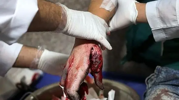 2 جوان شیرازی هنگام ساخت ترقه دچار سوختگی شدید شدند