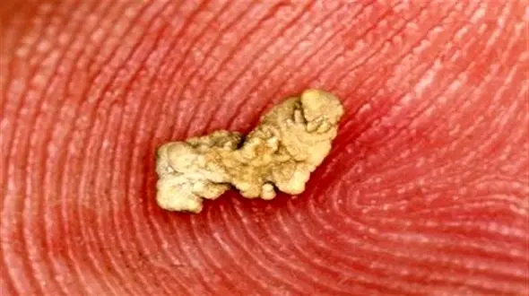 چگونه از سنگ کلیه پیشگیری کنیم؟