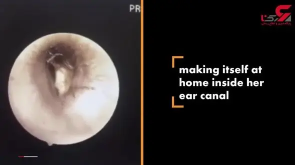 سوسک کثیف در گوش زن جوان لانه کرده بود+فیلم