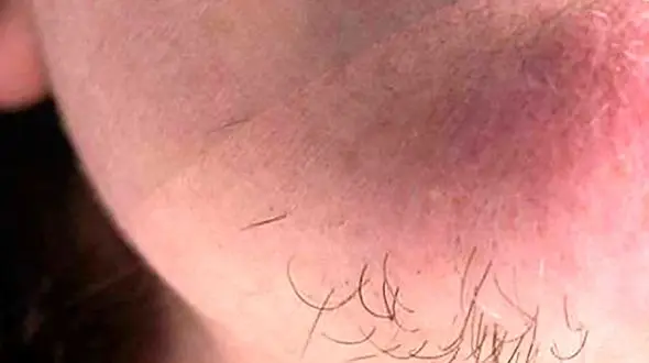 علل و درمان موهای زائد در زنان 