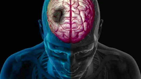فاجعه سکته در ایران؛ چرا 10 سال زودتر؟