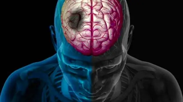 فاجعه سکته در ایران؛ چرا 10 سال زودتر؟