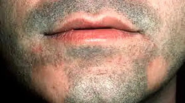 درمان خانگی قارچ ریش