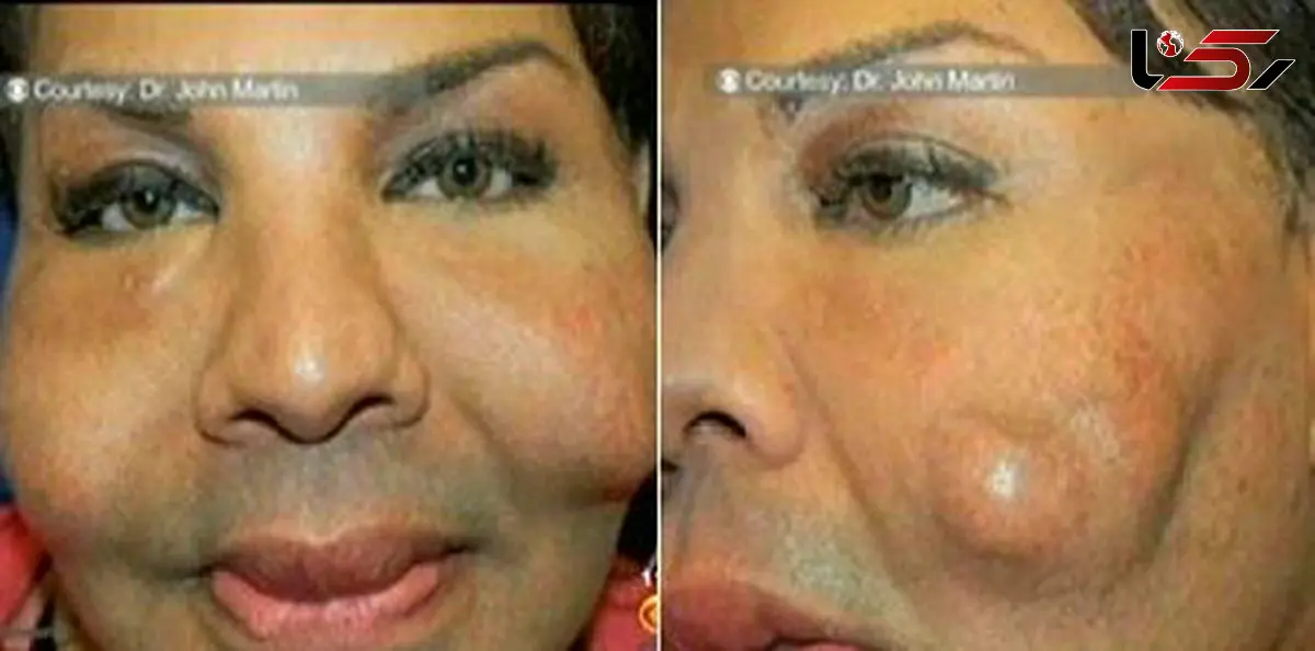 مردی عشوه آمد و دکتر به جای بوتاکس سیمان تزریق کرد + عکس