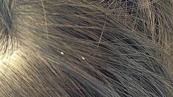 درمان‌های دارویی و خانگی رفع شپش سر