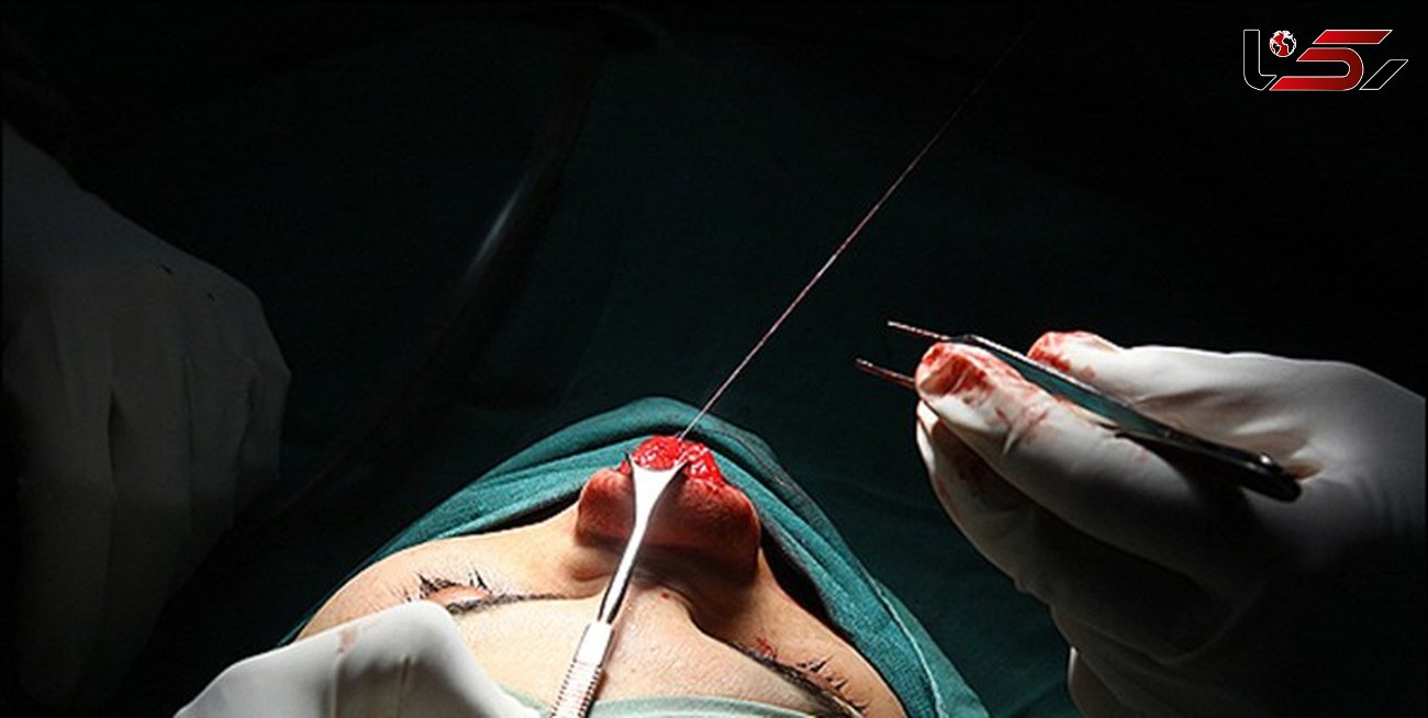 ردپای افراد غیر پزشک در جراحی زیبایی بینی
